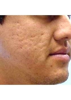 Cosmetic Dermatology Phenol Peel (Chemical Face-Lift) in Chula Vista ...