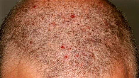 Why Do I Have Big, Small, Red Itchy Bumps on My Scalp? - American Celiac