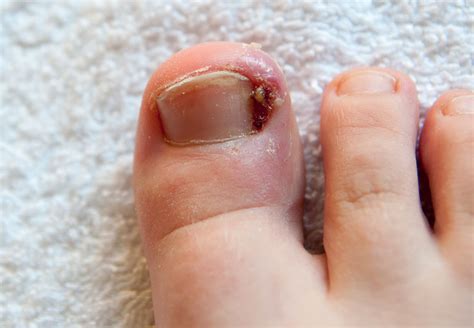 Diabetic Foot : Symptoms, Diagnosis and Treatment