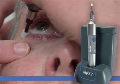 BlephEx Blepharitis treatment — The Eyesmith