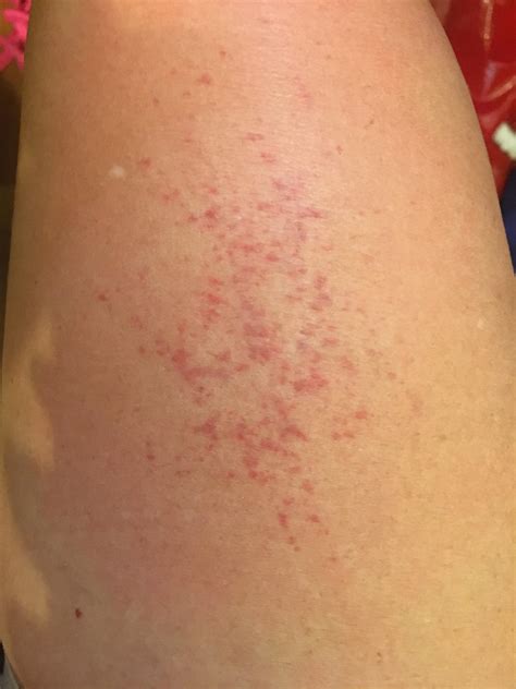 Every time I scratch, this is what happens and my skin is hot to the