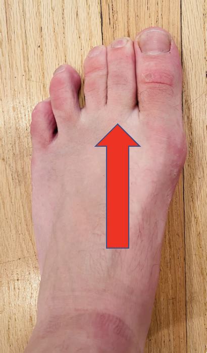 toe pain capsulitis    toe dr justin dean