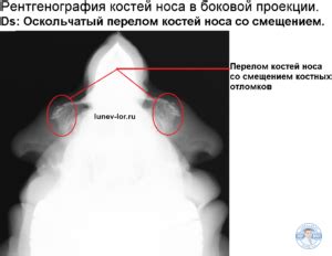 Перелом костей носа лечение в Самаре -ЛОР в Самаре - врач Лунёв Андрей ...