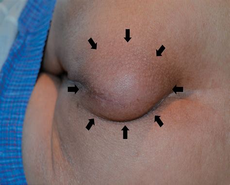 Perineal Hernia Human