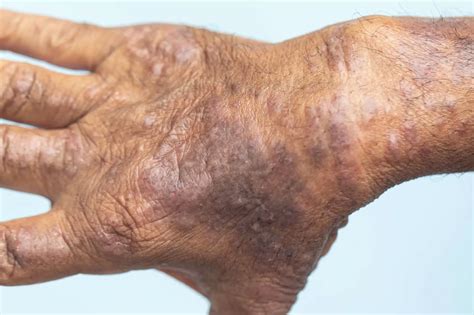 skin pigmentation  eczema national eczema society