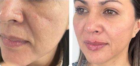 Harmonyca Antes E Depois