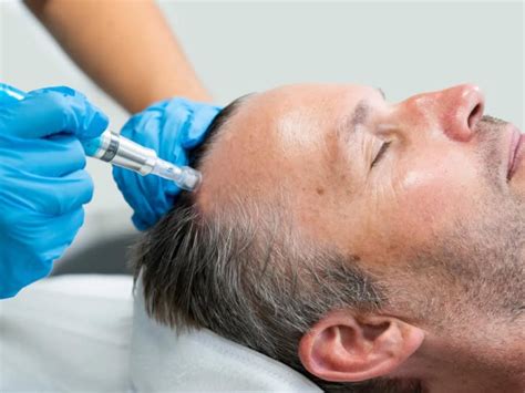 Hair Loss & Balding Treatment Melbourne | Non-Surgical Hair Growth for