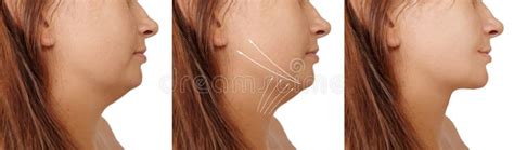 Woman Double Chin before and after Plastic Treatment Contour Stock ...