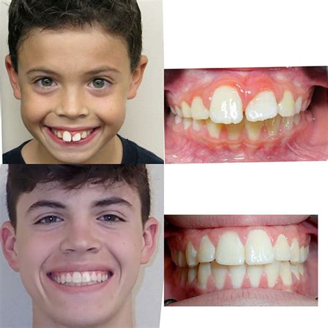 Before And After Braces