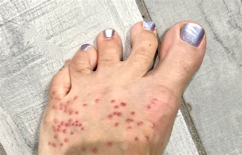 how to know if you have chiggers