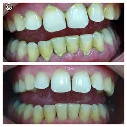Periodontite Antes E Depois - Tratamento Periodontal, Antes e Depois..., Caso clínico | iDent