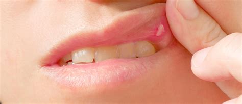 Canker Sore Cold Sore: What's The Difference?, 58% OFF