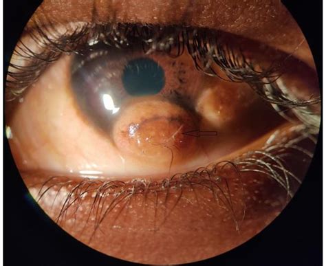 congenital limbal dermoid in a 10-year-old male | Download Scientific ...