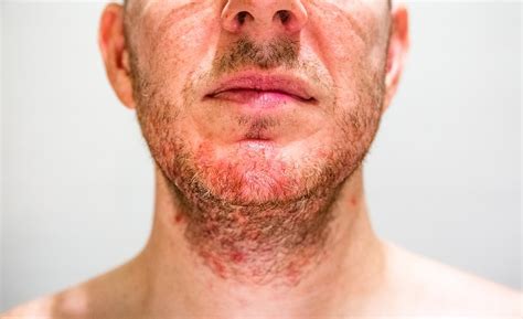 seborrheic dermatitis face african american