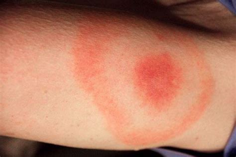 Bull’s-eye Tick Bite On Dogs (What You Need To Know)