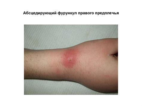 Гнойные заболевания кожи и подкожной клетчатки - презентация онлайн