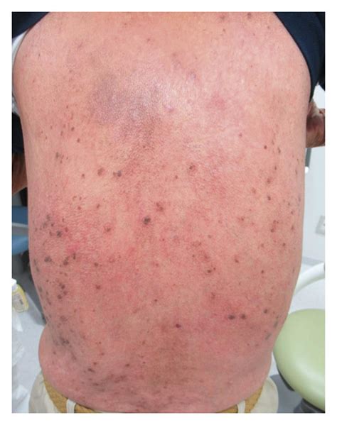 black spots    aaron levine blog