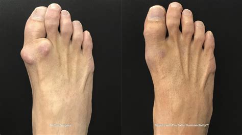 Arthritic Big Toe — Foot First Podiatry Centers