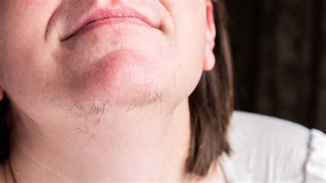Here are 6 reasons why you get hair on the chin | HealthShots