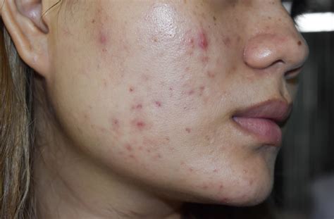 Acne Scarring Treatment: Prevention And Procedures For Minimizing Post