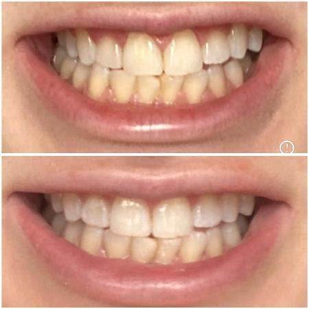 Colgate Luminous White Antes E Depois - Caneta clareadora da Colgate faz sucesso e está com 44% OFF, confira