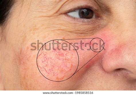 red swollen capillaries  face royalty  images stock
