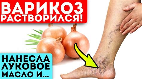 Стирает вены и узлы как ластик! Боль в ногах прошла после простого ...