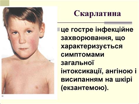 Диференціальна діагностика захворювань із синдромом екзантеми ...