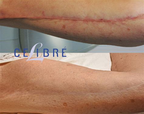scar removal    pictures