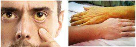 jaundice-symptoms – Positive Pathways