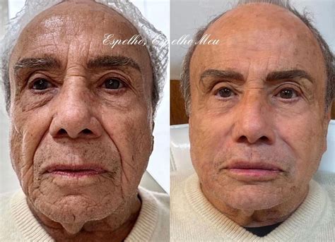Stênio Garcia Antes E Depois - Influenciadora Belle Belinha faz harmonização facial; veja antes e depois