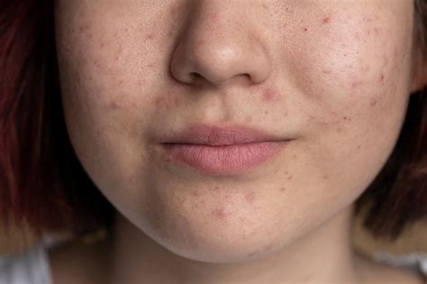 Does Eating Eggs Cause Pimples? What Science Says About Eggs and Acne