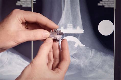 Ankle Replacement Surgery | Surgical Treatment Options | Exactech