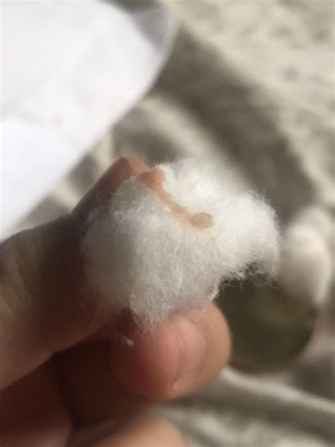 Draining sebaceous cyst : r/popping