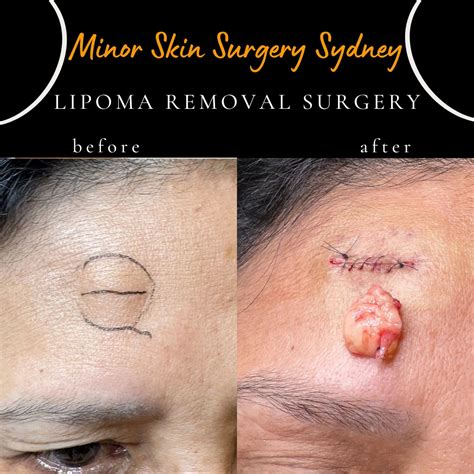 Lipoma surgery, Treatment, Removal Sydney - Dr Lipoma Popper Sydney ...