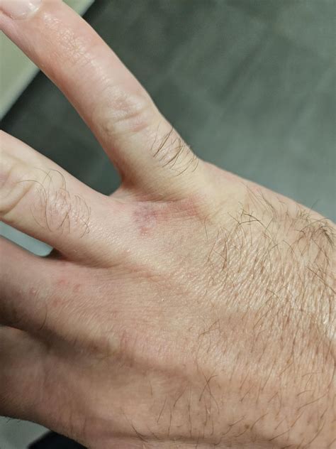 What are these bumps on my hands : r/DiagnoseMe