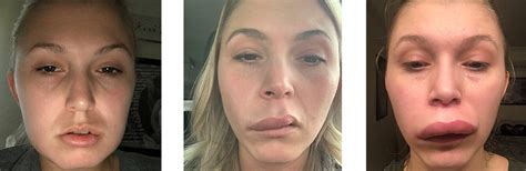 hereditary angioedema association