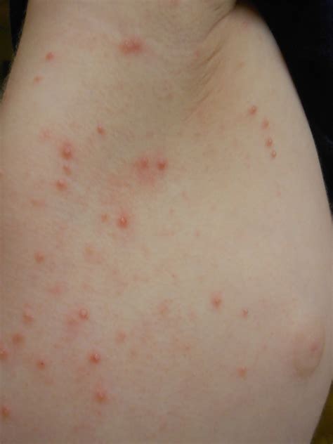 roseola in toddler - pictures, photos