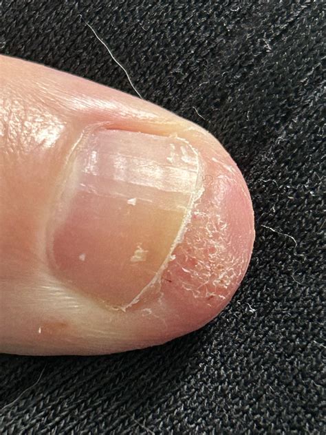 More progress. My thumb looks like a toe. : r/Warts