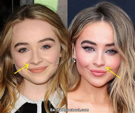 Sabrina Carpenter Antes E Depois - Sabrina Carpenter Plastic Surgery Comparison Photos
