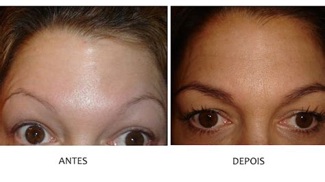 Antes E Depois Minoxidil - MINOXIDIL - Saiba tudo sobre o Minoxidil: Minoxidil Antes e Depois