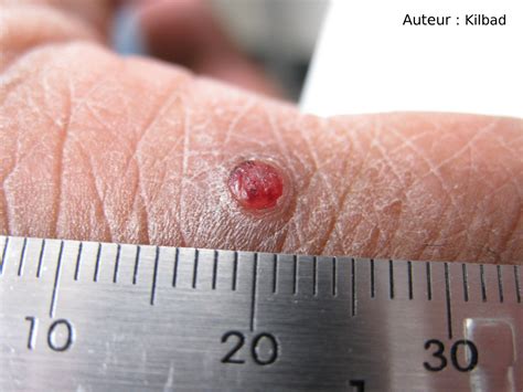 Botriomycome - Granulome pyogénique : définition - docteurclic.com