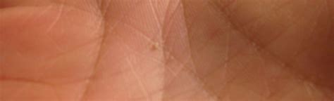 Small Itchy Bumps On The Palm Of My Hand - vrogue.co