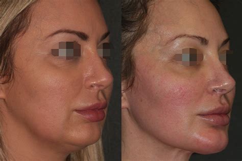BeautiFill Laser Lipo — Symbios Health, Primary Care