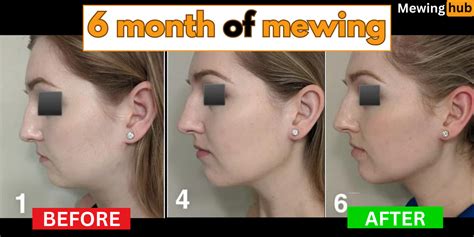 Before and After Mewing: 6 Month Transformation Analysis | Mewinghub