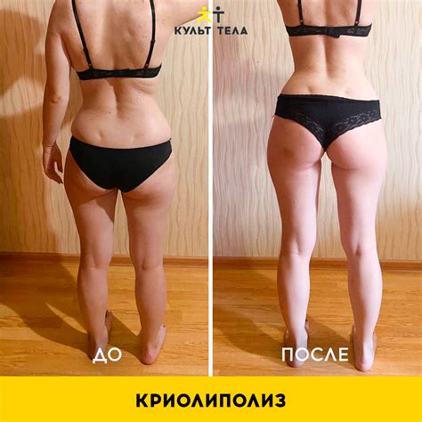 Криолиполиз цена в Москве на процедуру