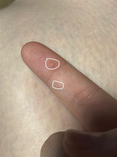 what type of warts and why? : r/Warts
