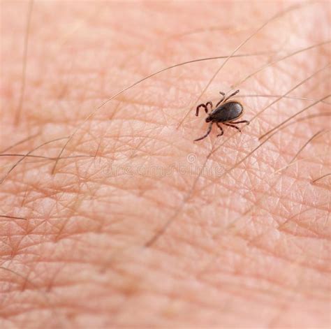 a tick sitting on the skin of someone's hand