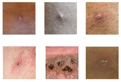 Idaho reports a first case of what appears to be local monkeypox ...