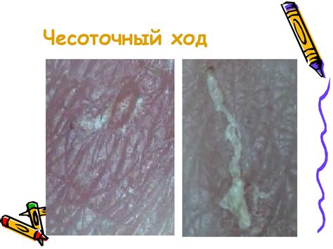 Чесотка, заразное паразитарное заболевание кожи - презентация онлайн